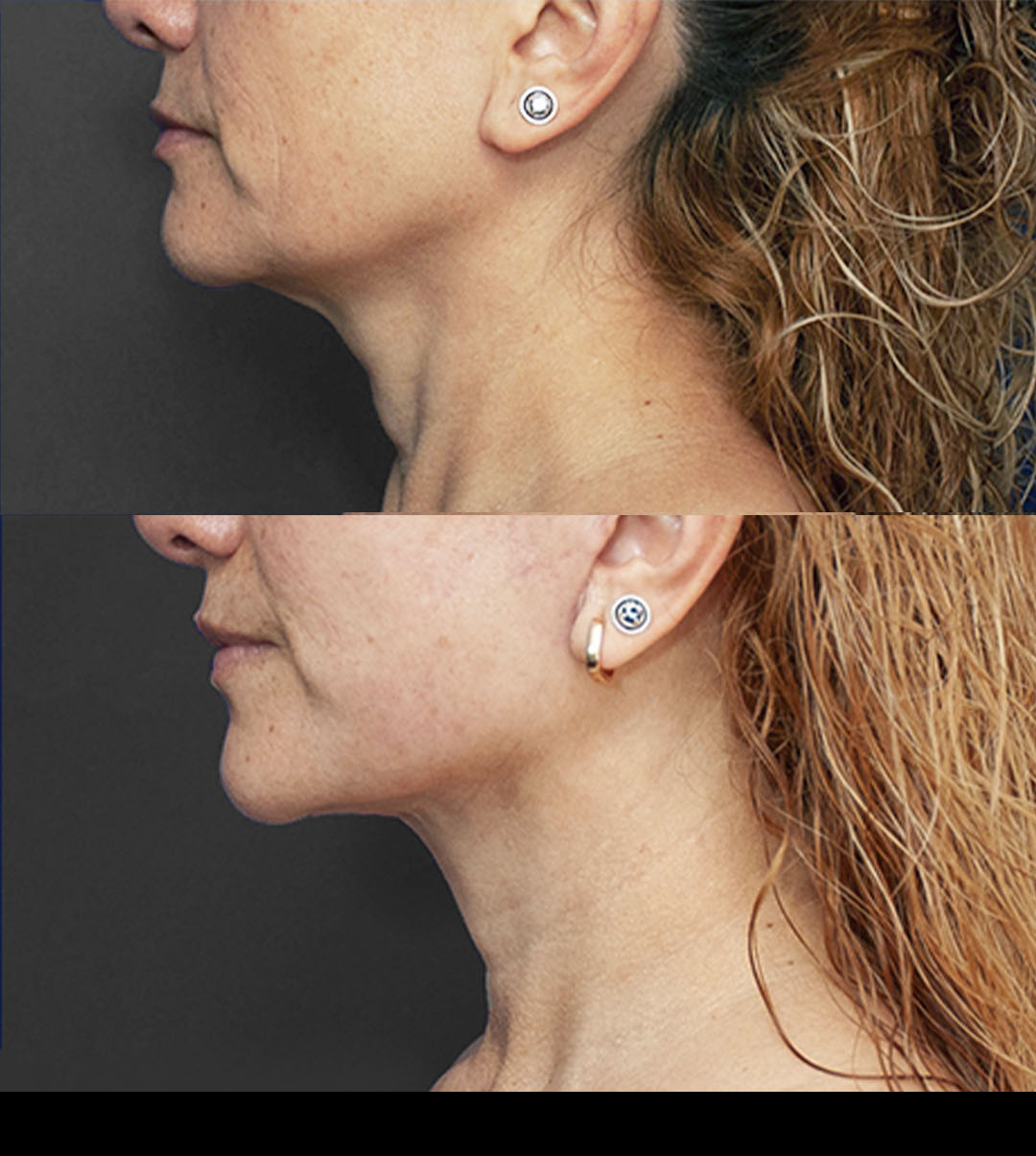 Resultado cervicoplastia